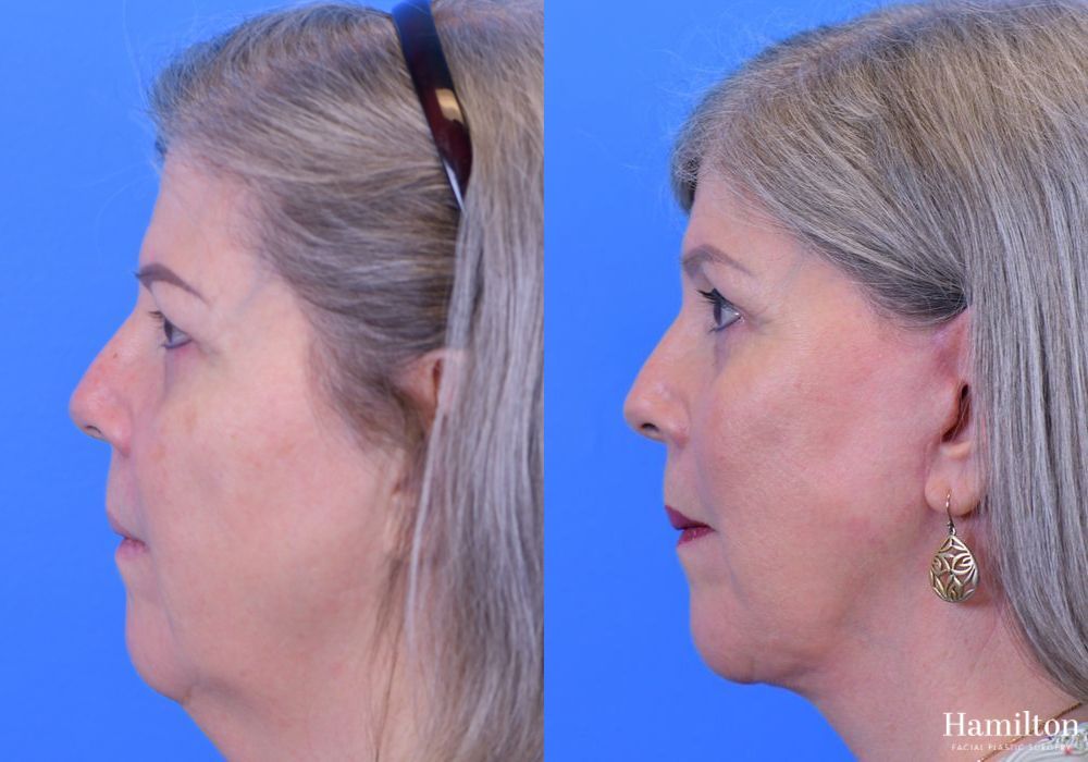 Before and after Facelift case 37278 - Angle 2