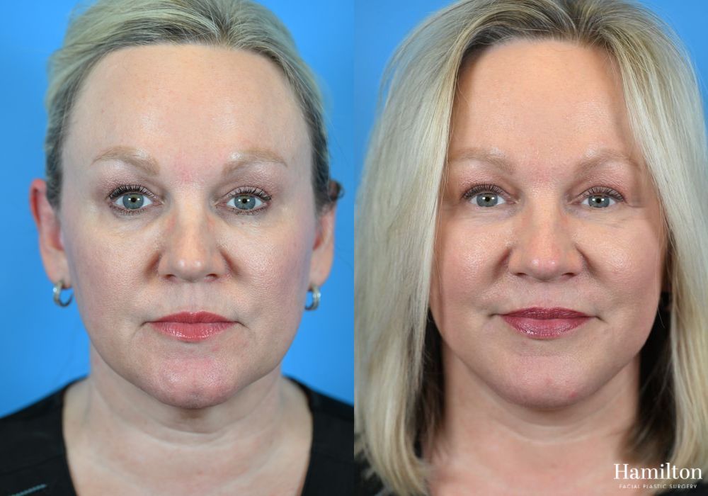 Before and after Facelift case 37317 - Angle 5