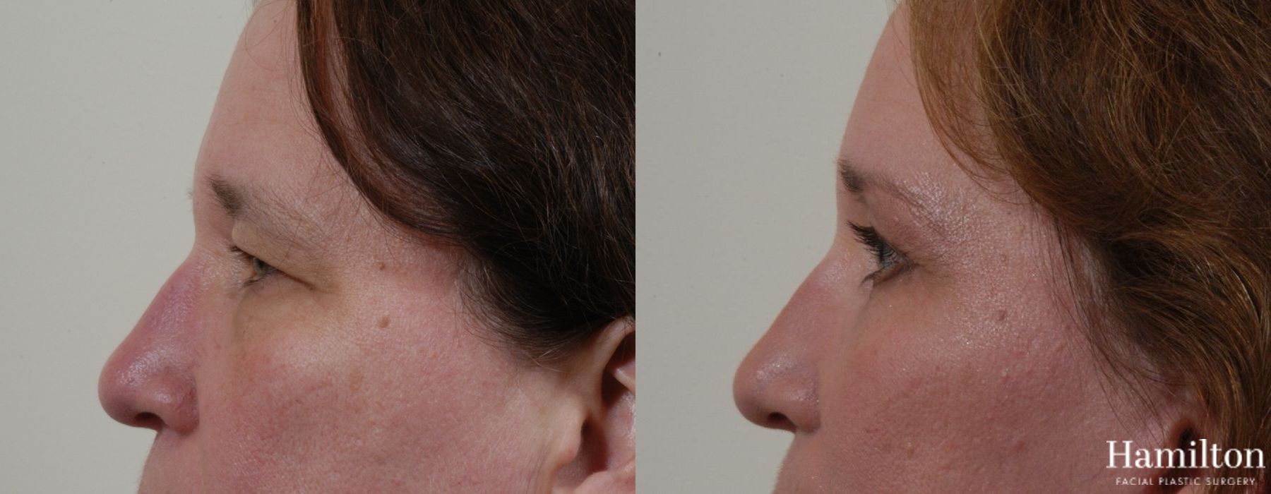 Before and after Blepharoplasty case 37270 - Angle 3