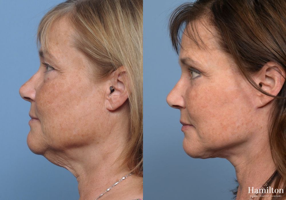Before and after Facelift case 37258 - Angle 4