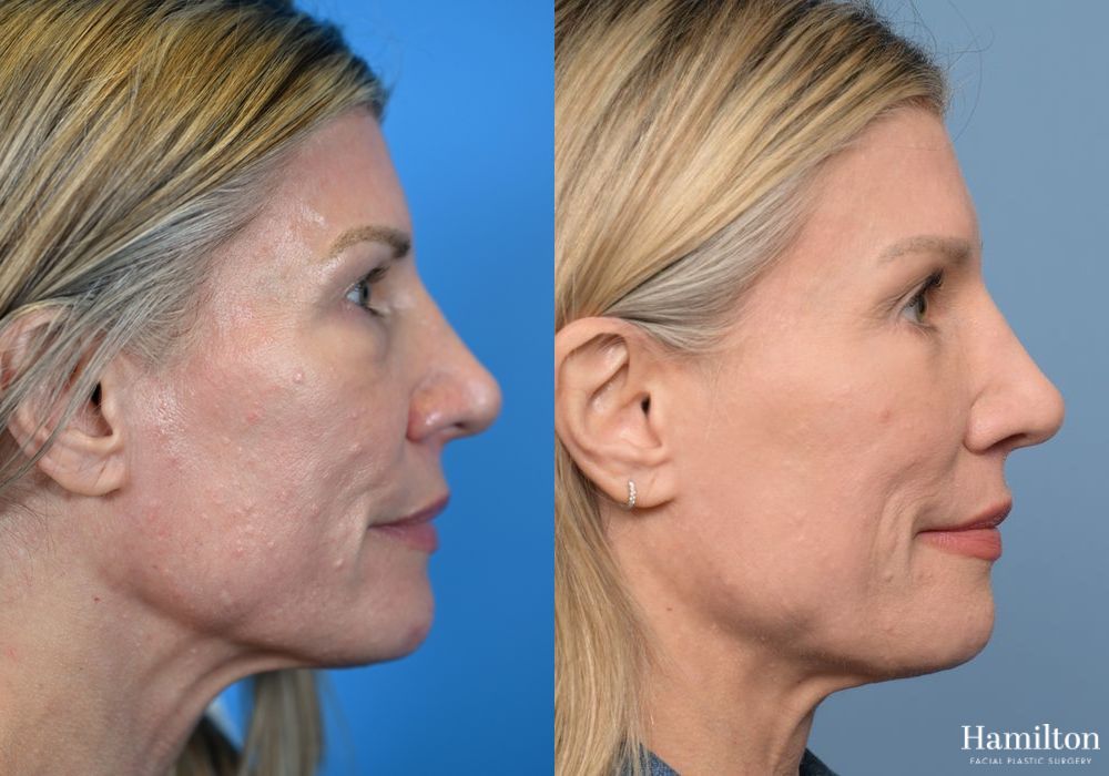 Before and after Brow Lift case 37196 - Angle 4