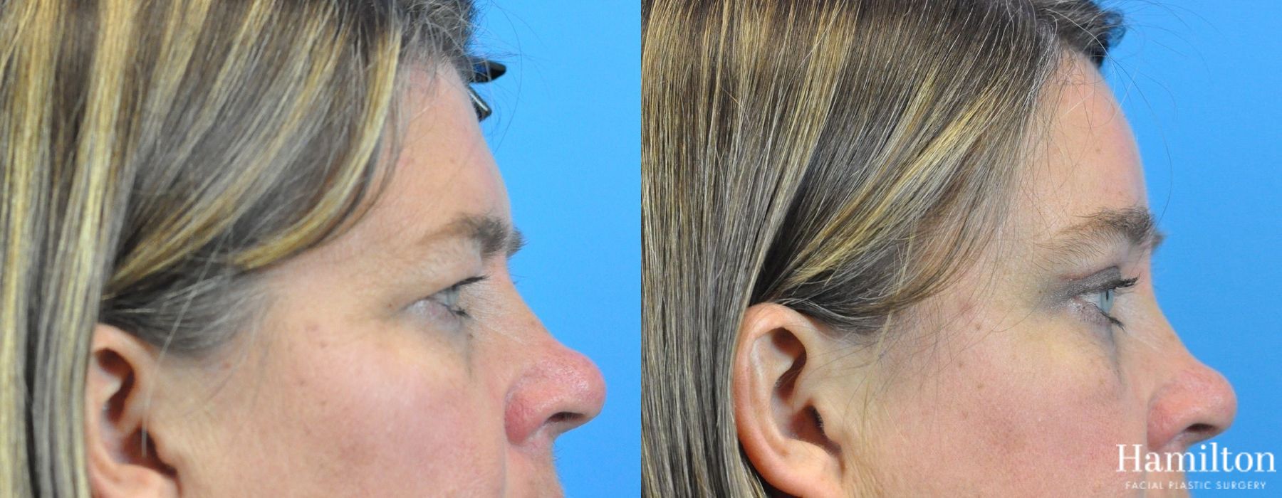 Before and after Blepharoplasty case 37272 - Angle 5