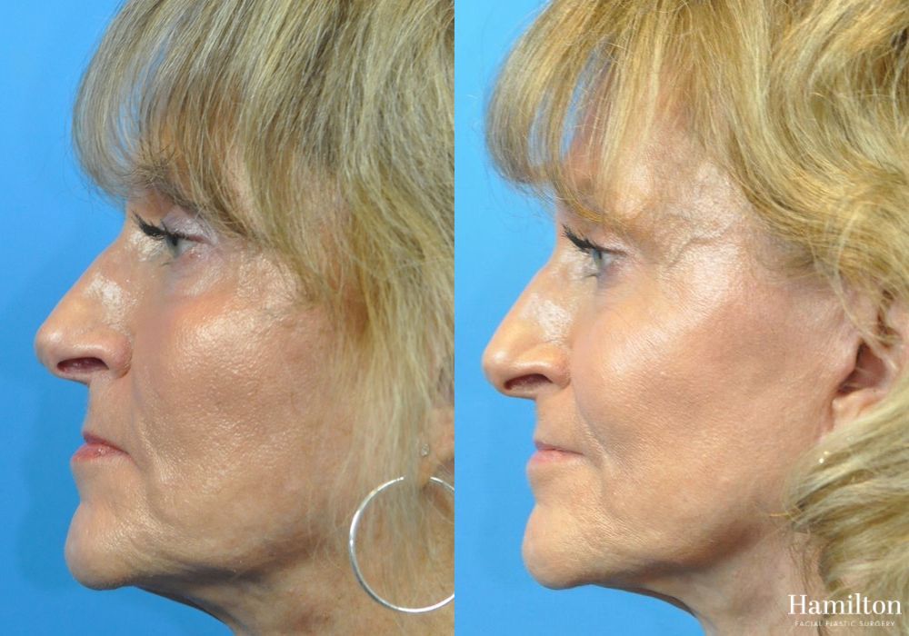 Before and after Cheek Augmentation case 37349