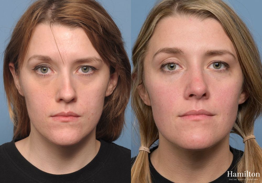 Before and after Rhinoplasty case 37136 - Angle 4