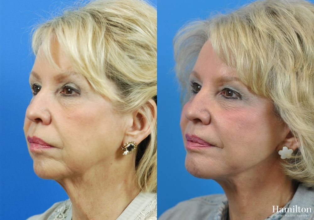 Before and after Chin Augmentation case 37193 - Angle 4