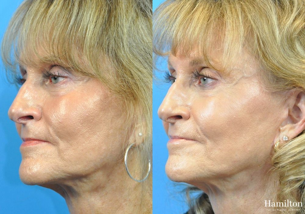 Before and after Cheek Augmentation case 37349 - Angle 2