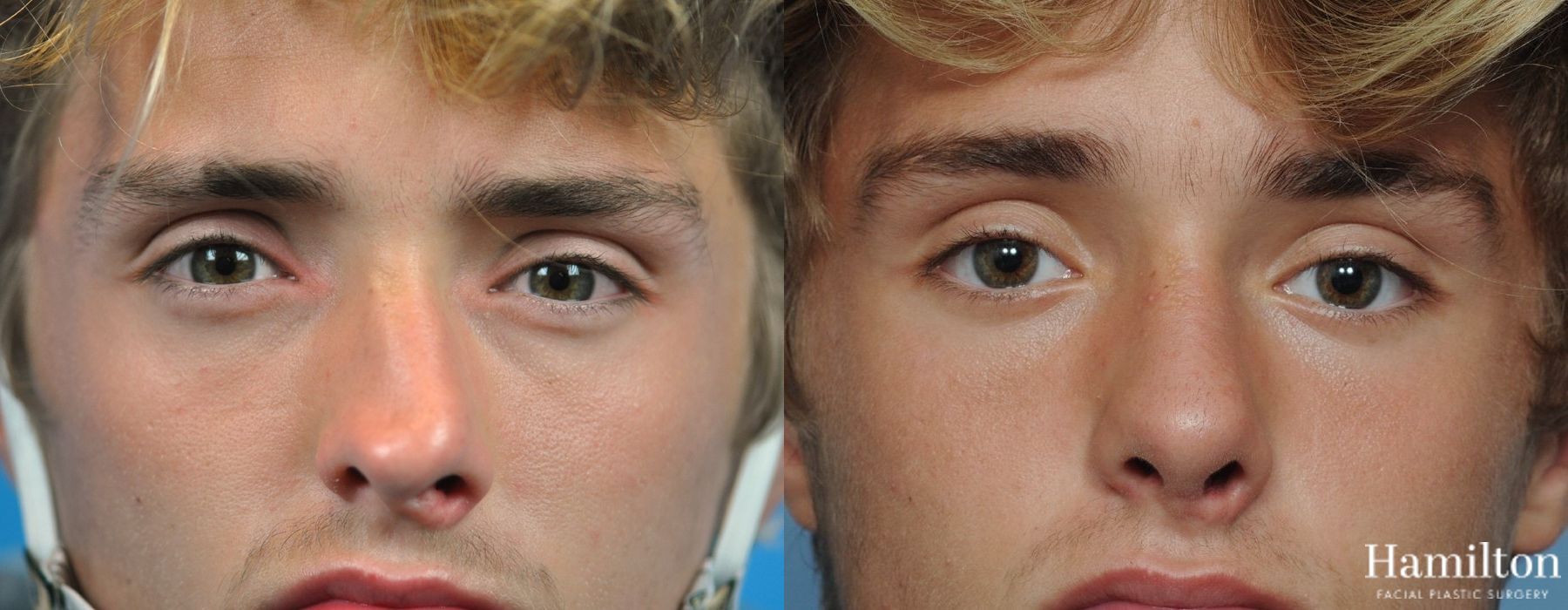 Before and after Rhinoplasty case 37244