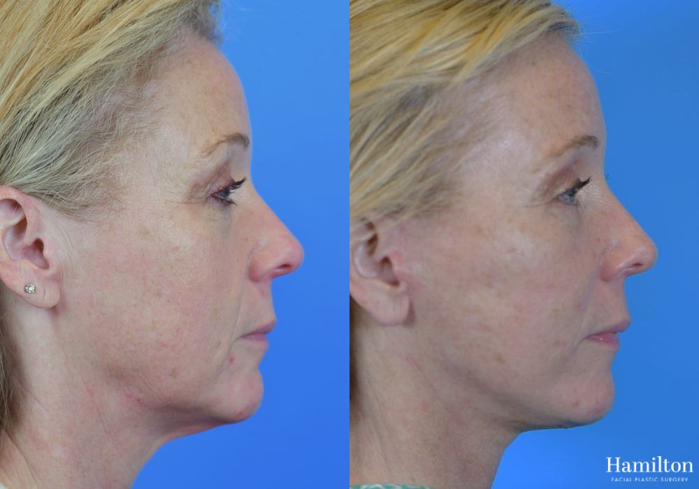 Before and after Facelift case 37316 - Angle 2