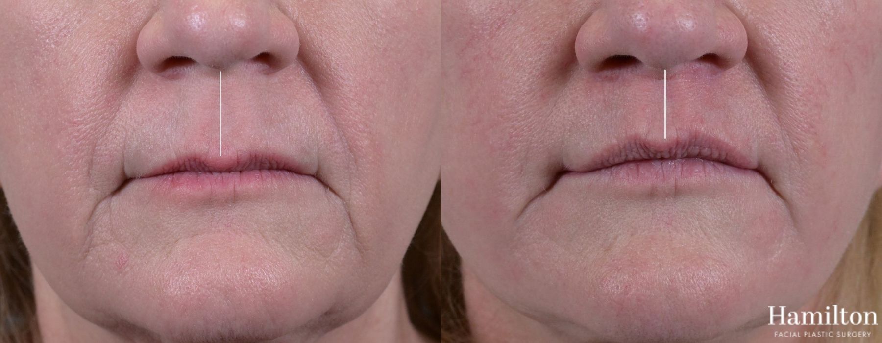 Before and after Lip Enhancement case 37184