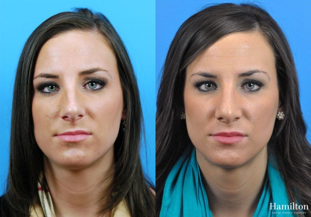 Before and after Rhinoplasty case 37287 - Angle 4