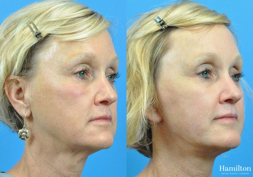 Before and after Facelift case 37322 - Angle 2