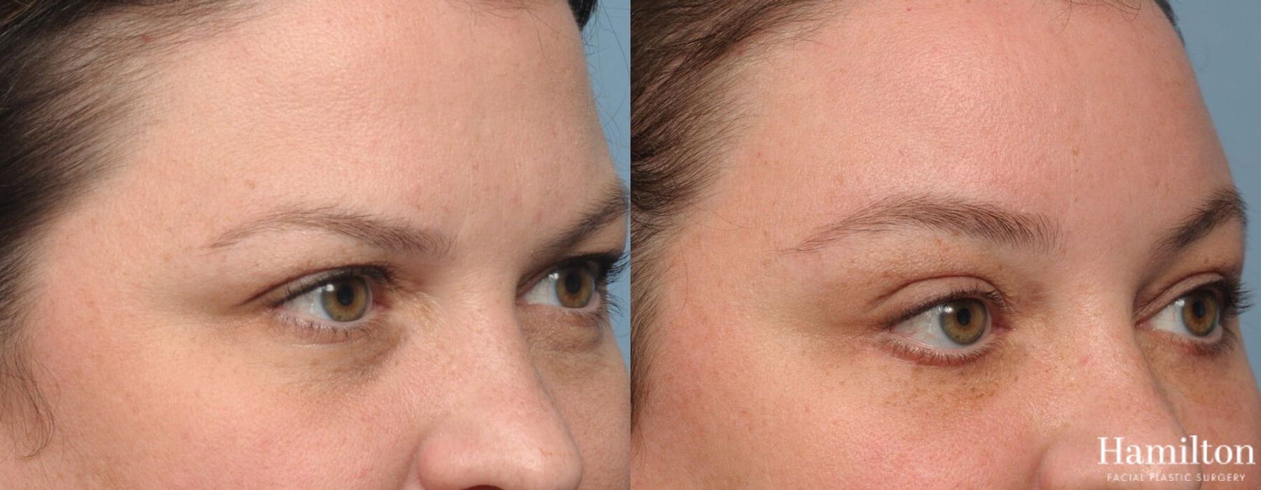 Before and after Brow Lift case 37086 - Angle 4