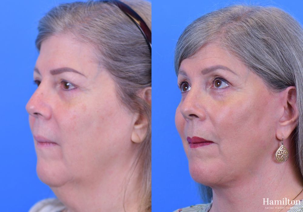 Before and after Facelift case 37278 - Angle 4