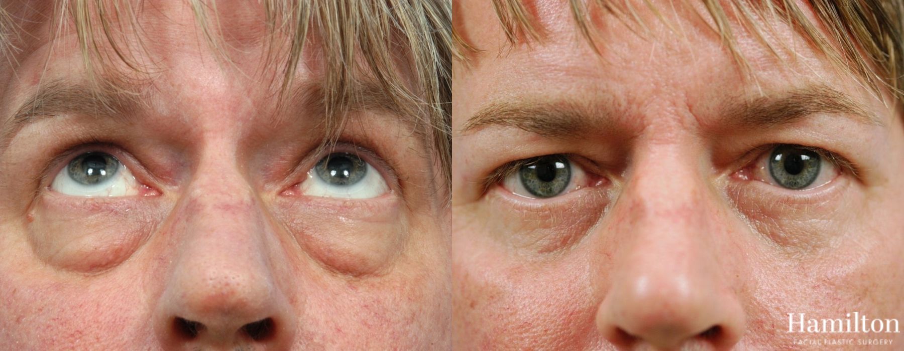 Before and after Blepharoplasty case 37309