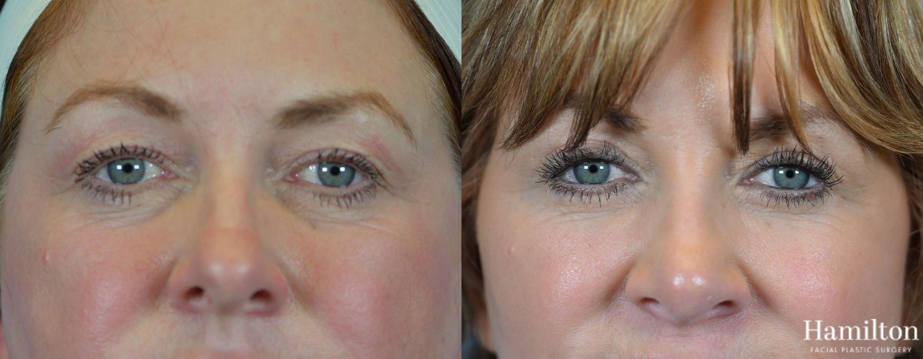 Before and after Blepharoplasty case 37277 - Angle 3