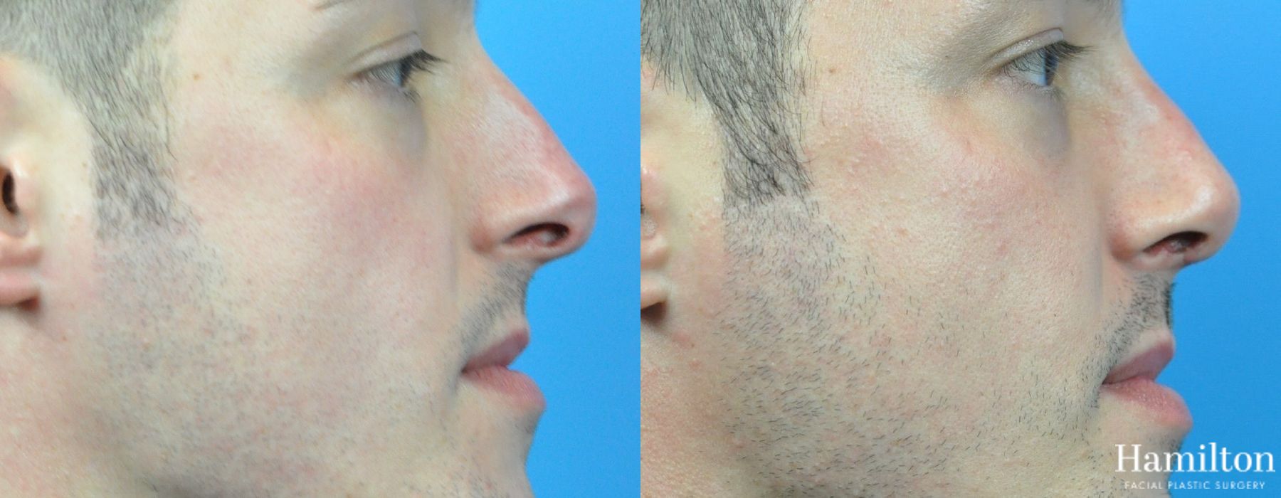 Before and after Rhinoplasty case 37333 - Angle 5