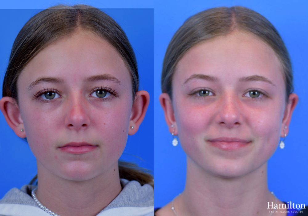 Before and after Otoplasty case 37365