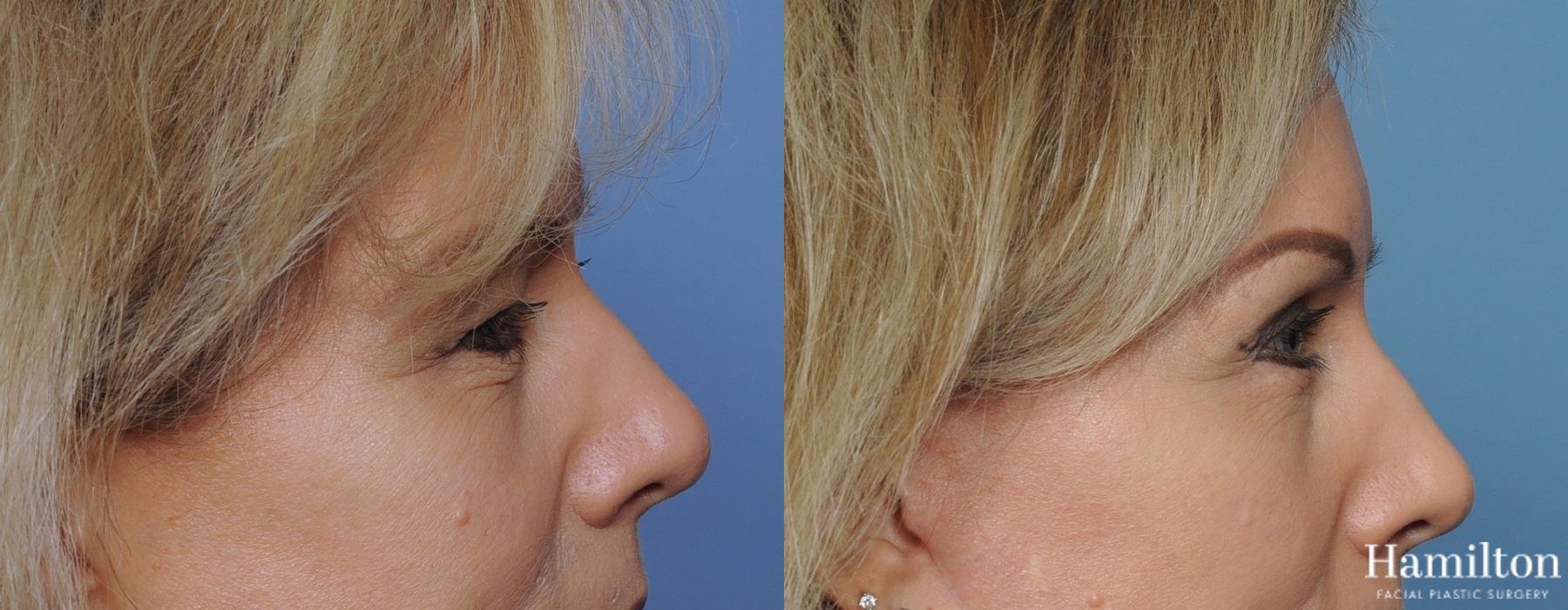Before and after Blepharoplasty case 37253 - Angle 5