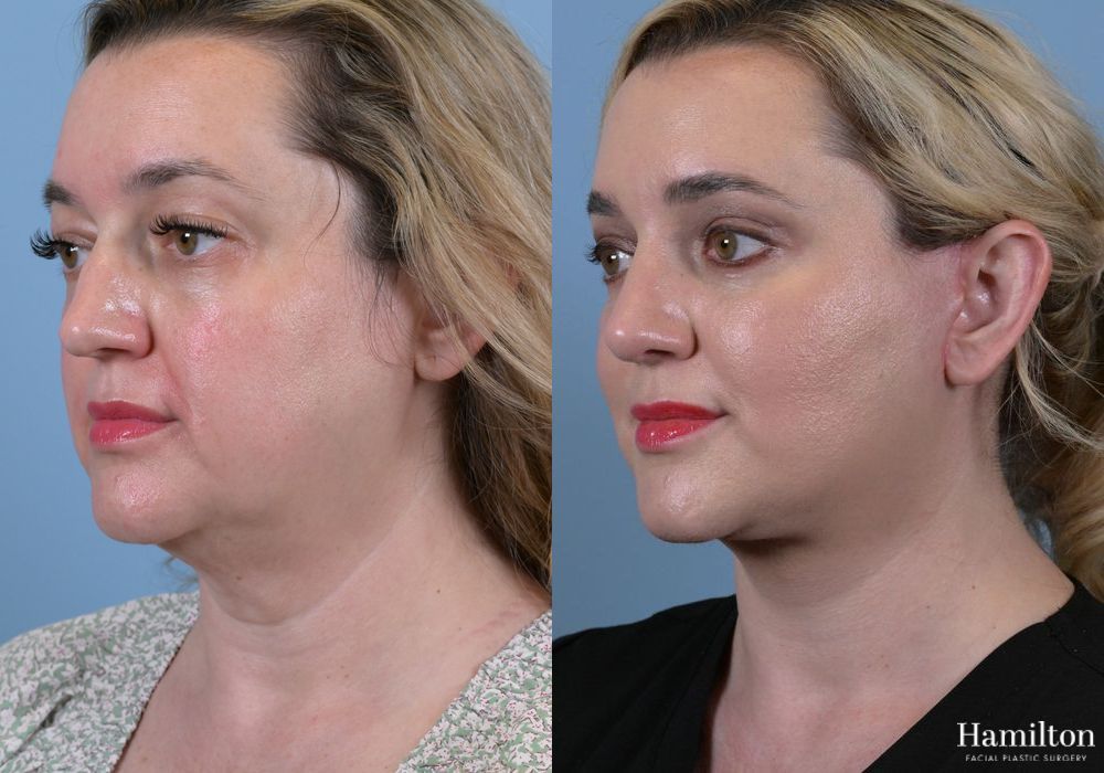 Before and after Facelift case 37138 - Angle 4