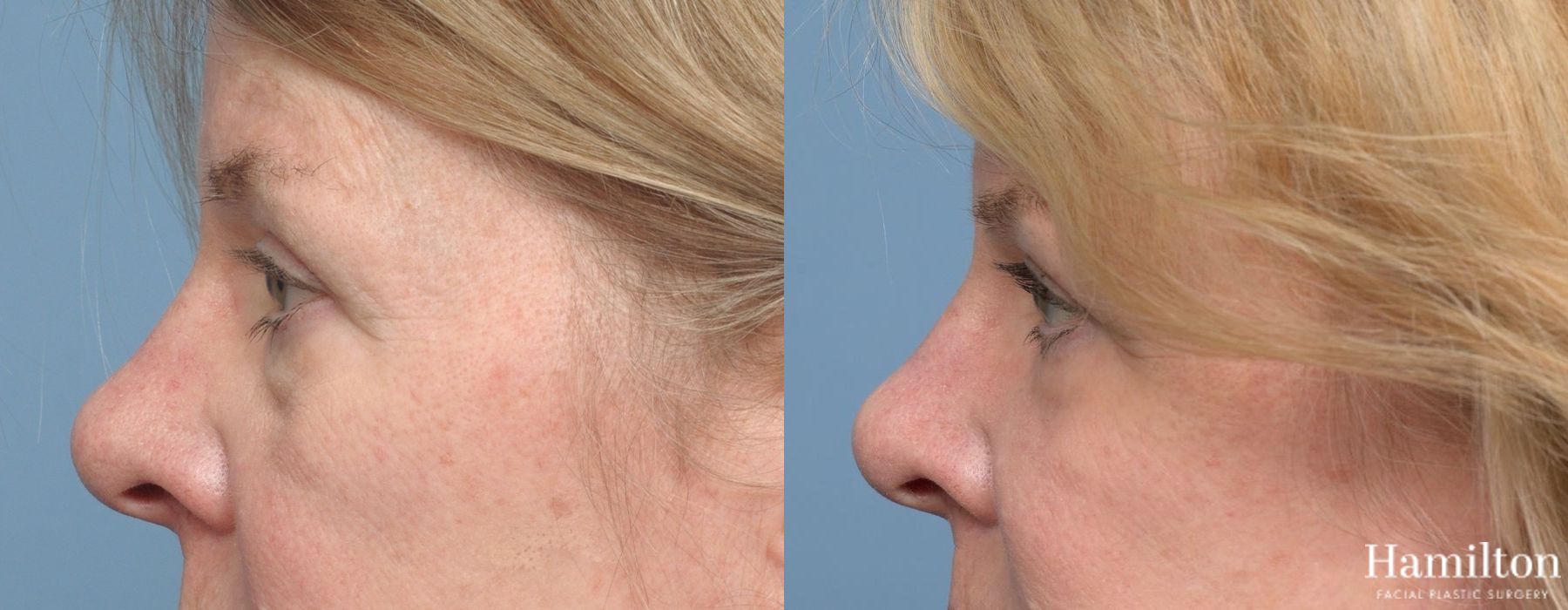 Before and after Blepharoplasty case 37230 - Angle 5