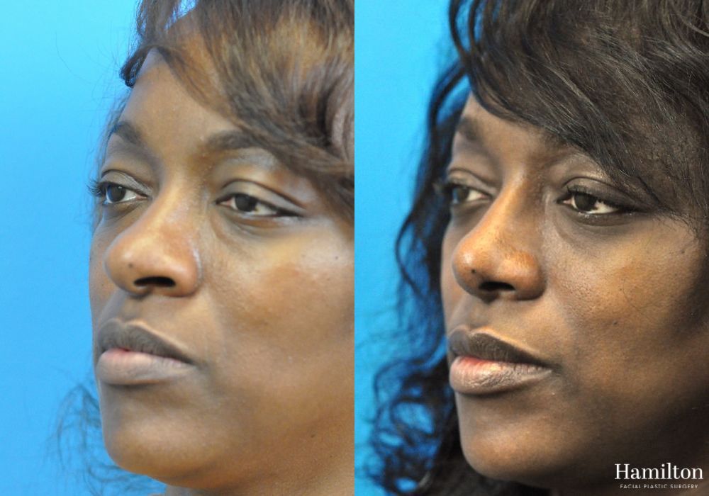 Before and after Rhinoplasty case 37295 - Angle 5