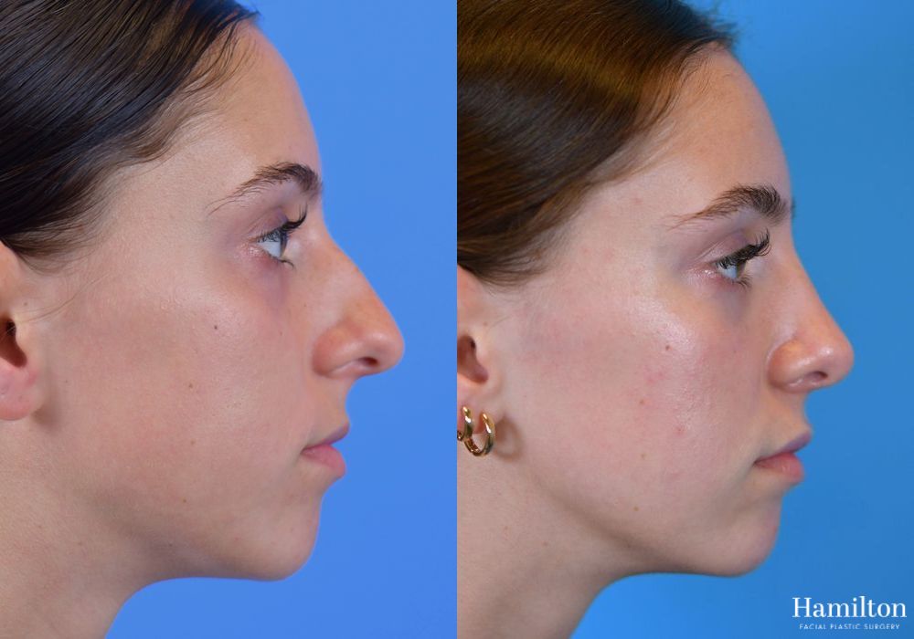 Before and after Rhinoplasty case 37198