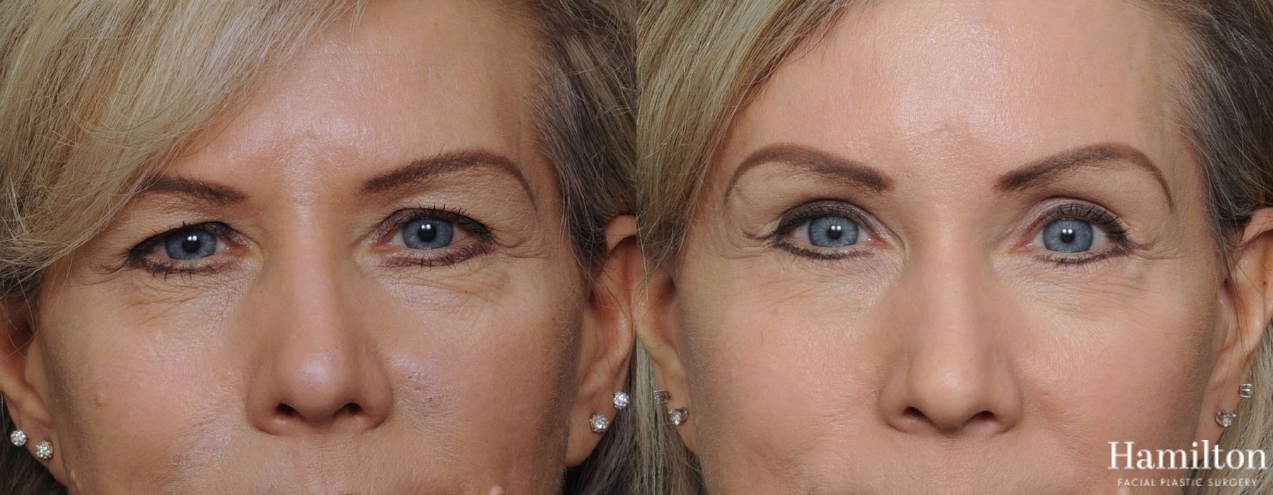 Before and after Blepharoplasty case 37253 - Angle 3