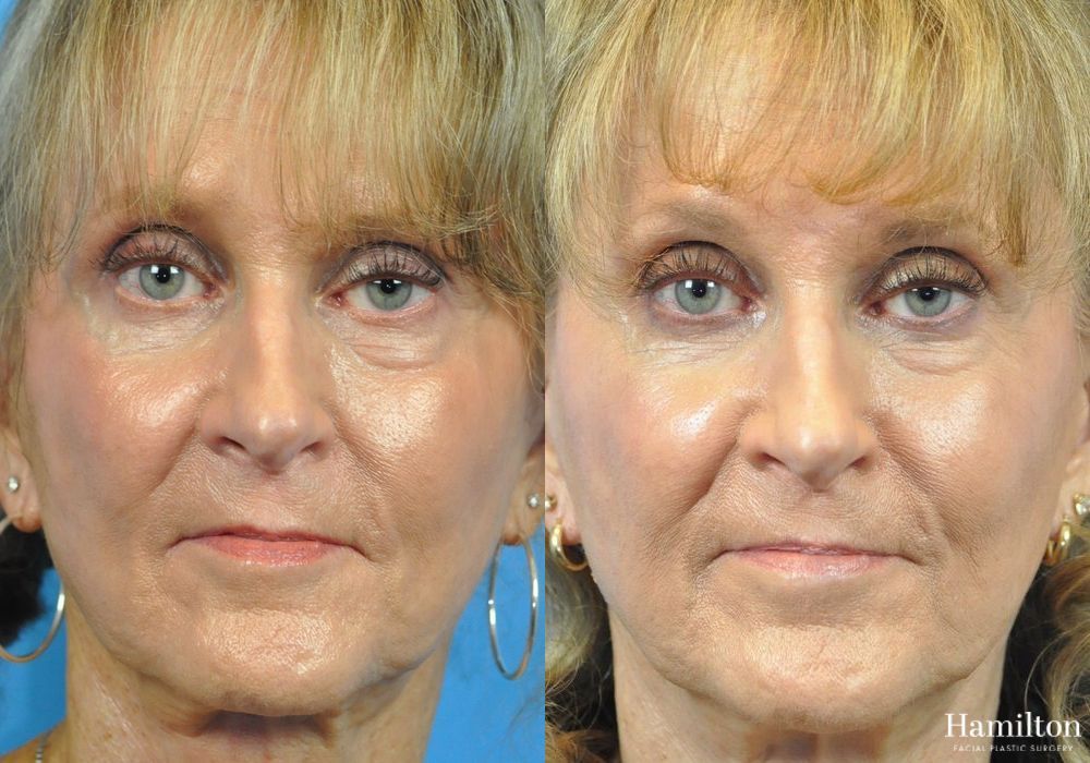 Before and after Cheek Augmentation case 37349 - Angle 3