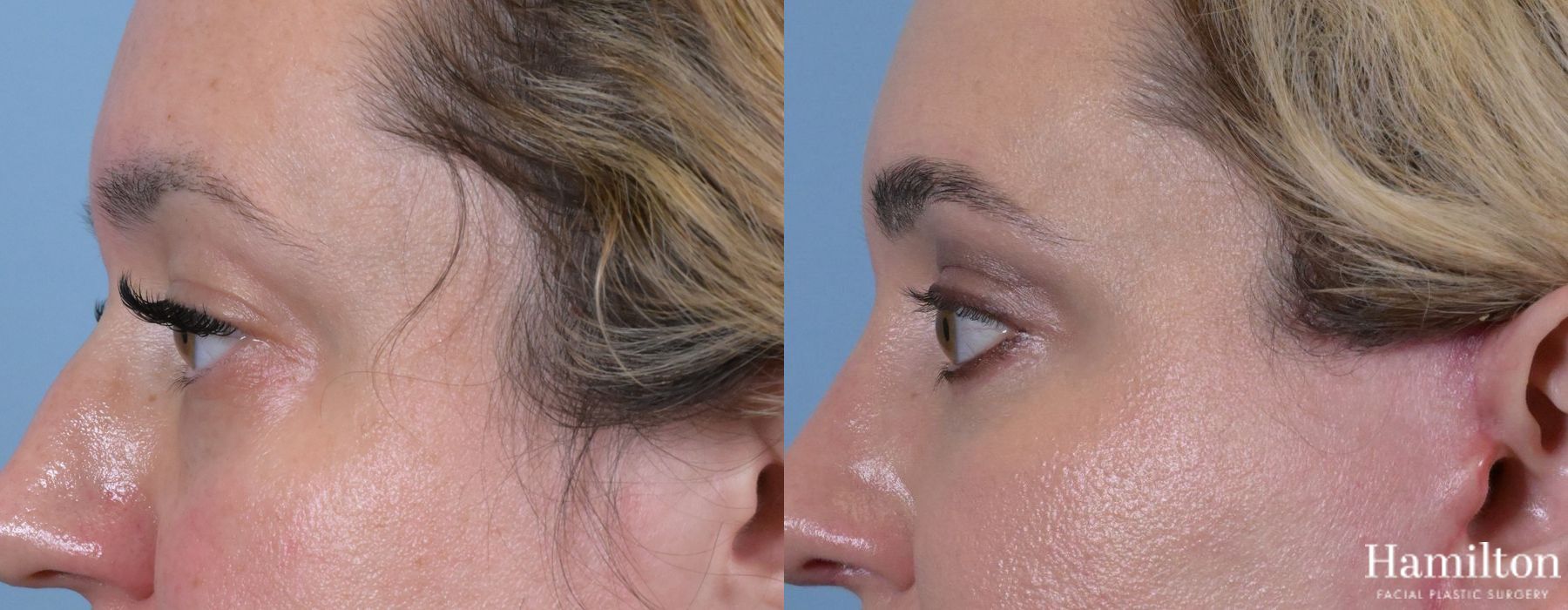 Before and after Blepharoplasty case 37133 - Angle 5