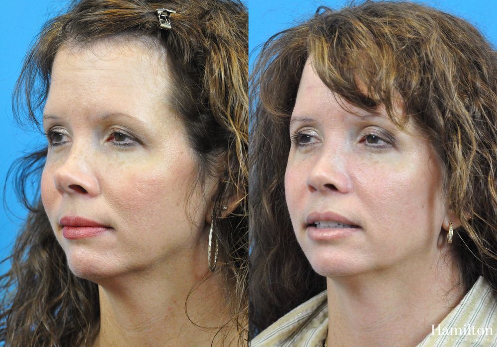 Before and after Rhinoplasty case 37292 - Angle 3