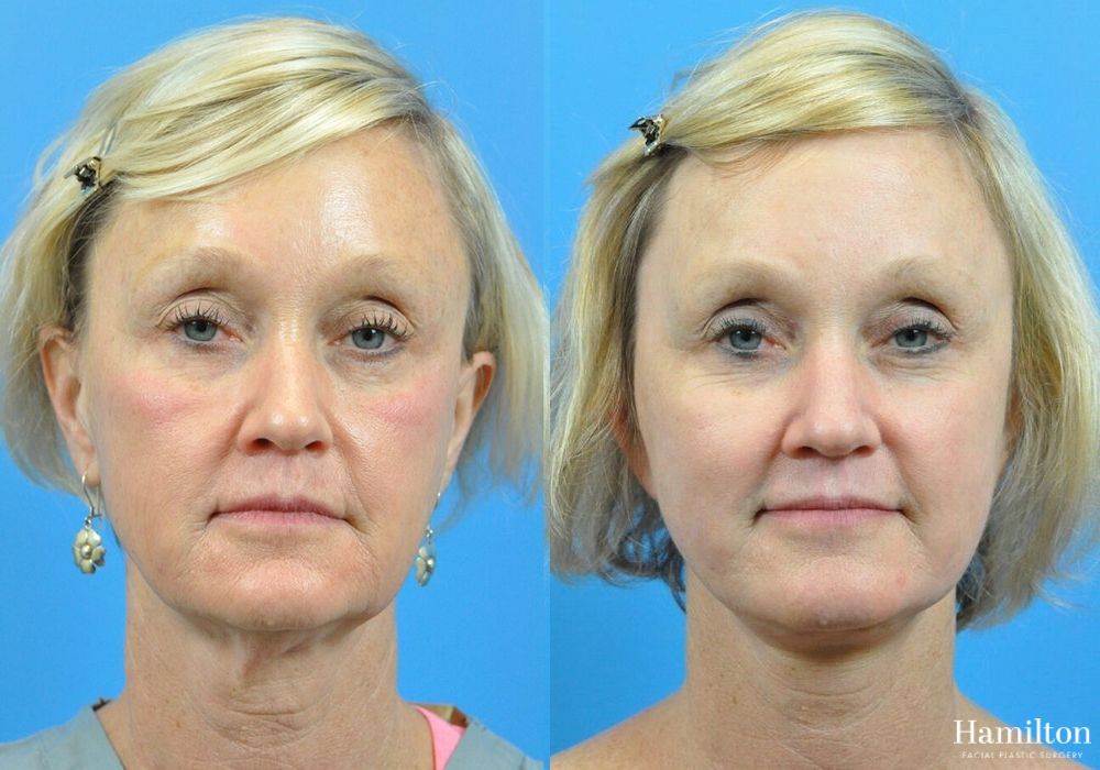 Before and after Facelift case 37322