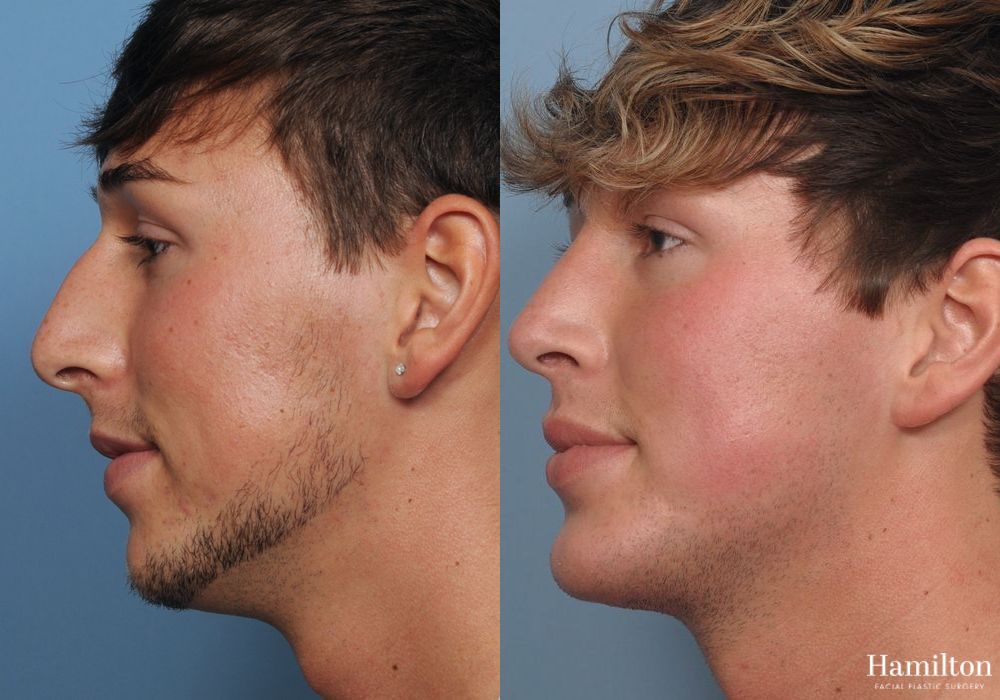 Before and after Chin Augmentation case 37085