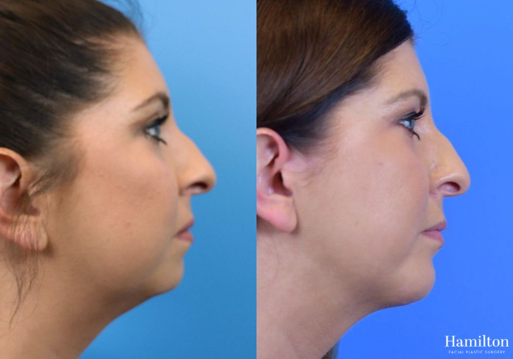 Before and after Chin Augmentation case 37218 - Angle 5