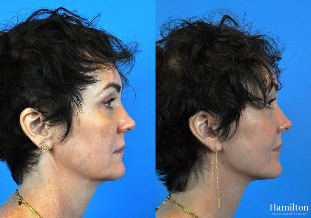 Before and after Mini Facelift case 37095 - Angle 2