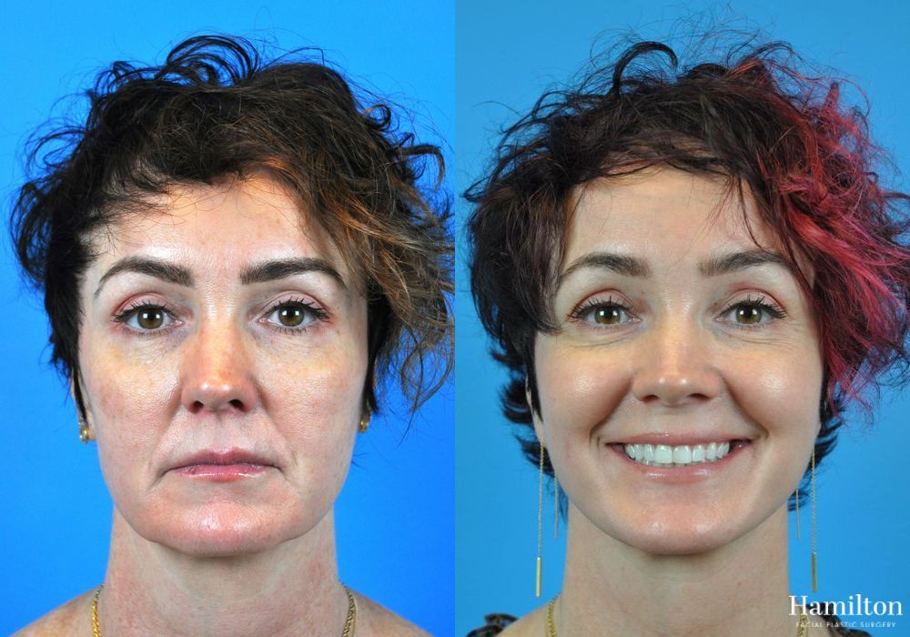 Before and after Mini Facelift case 37095 - Angle 4