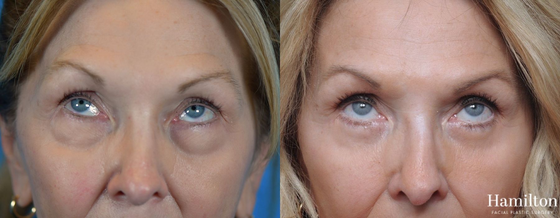 Before and after Blepharoplasty case 37129