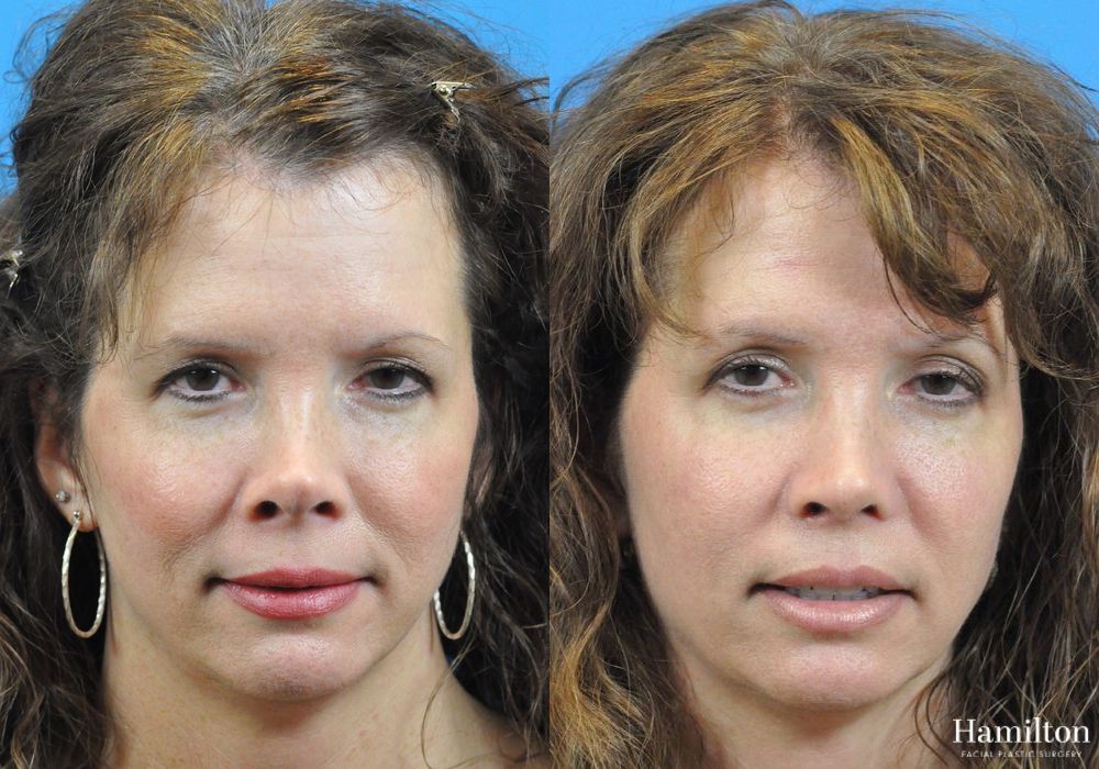 Before and after Rhinoplasty case 37292 - Angle 4