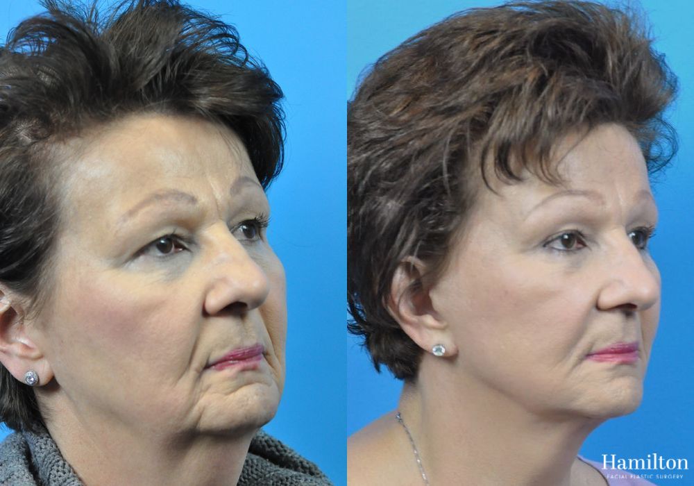 Before and after Facelift case 37325 - Angle 3