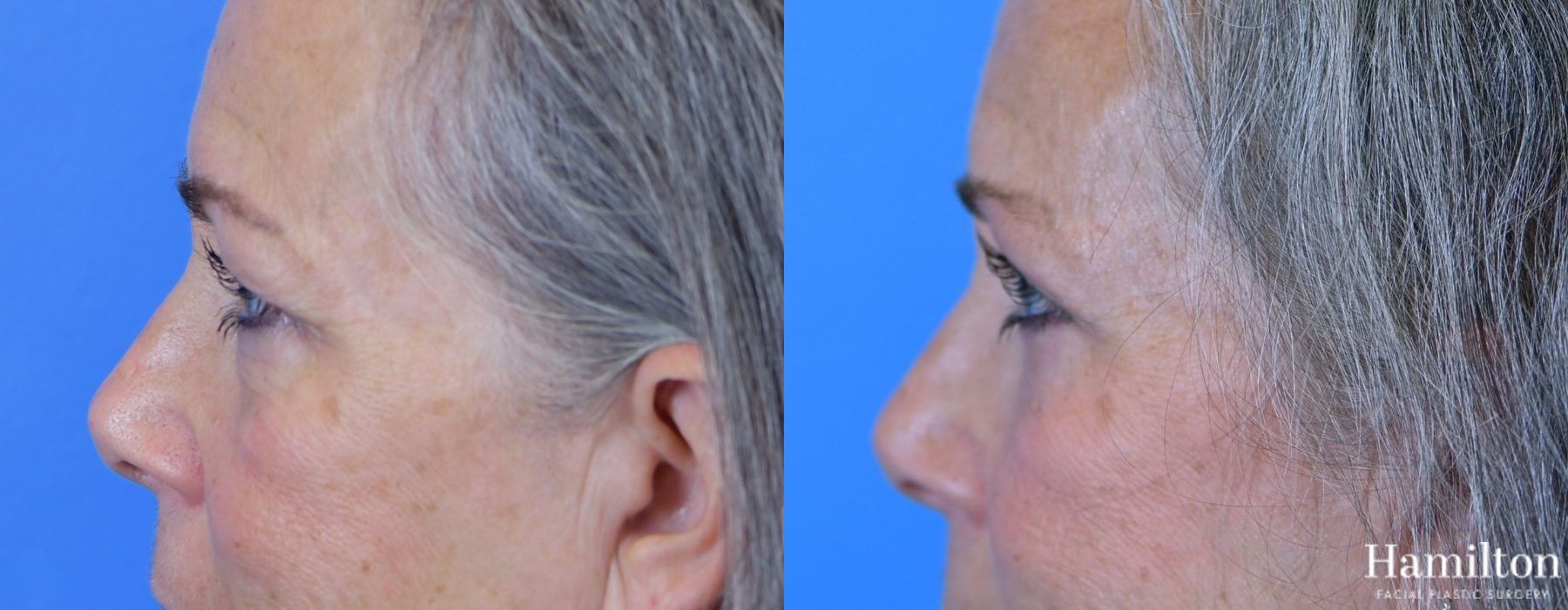 Before and after Blepharoplasty case 37267 - Angle 5