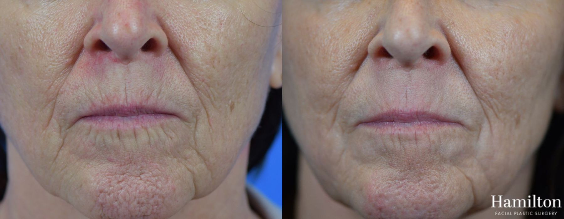 Before and after Laser - Sciton case 37145