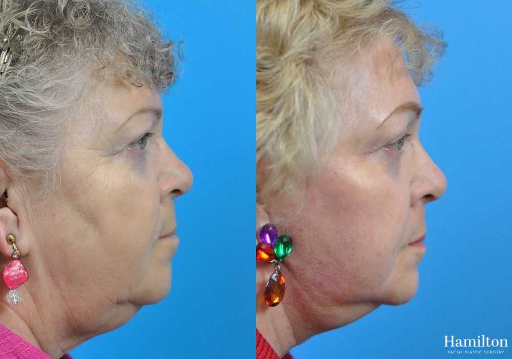 Before and after Laser - CO2 case 37210 - Angle 4