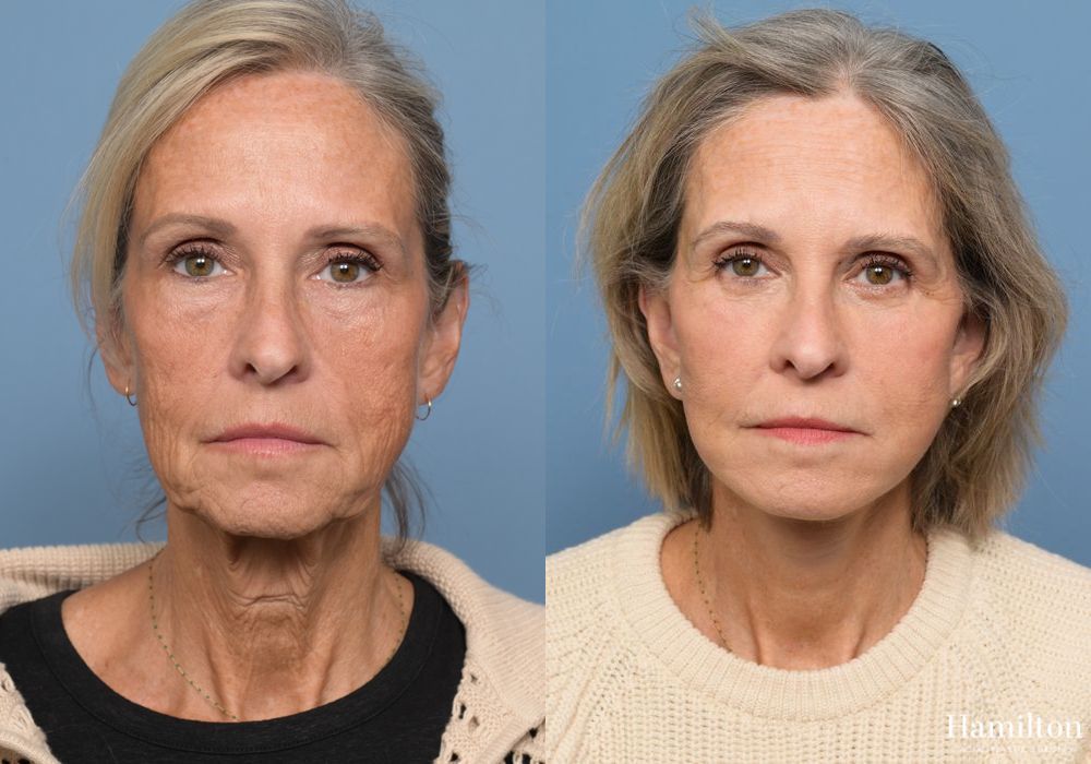 Before and after Facelift case 37219