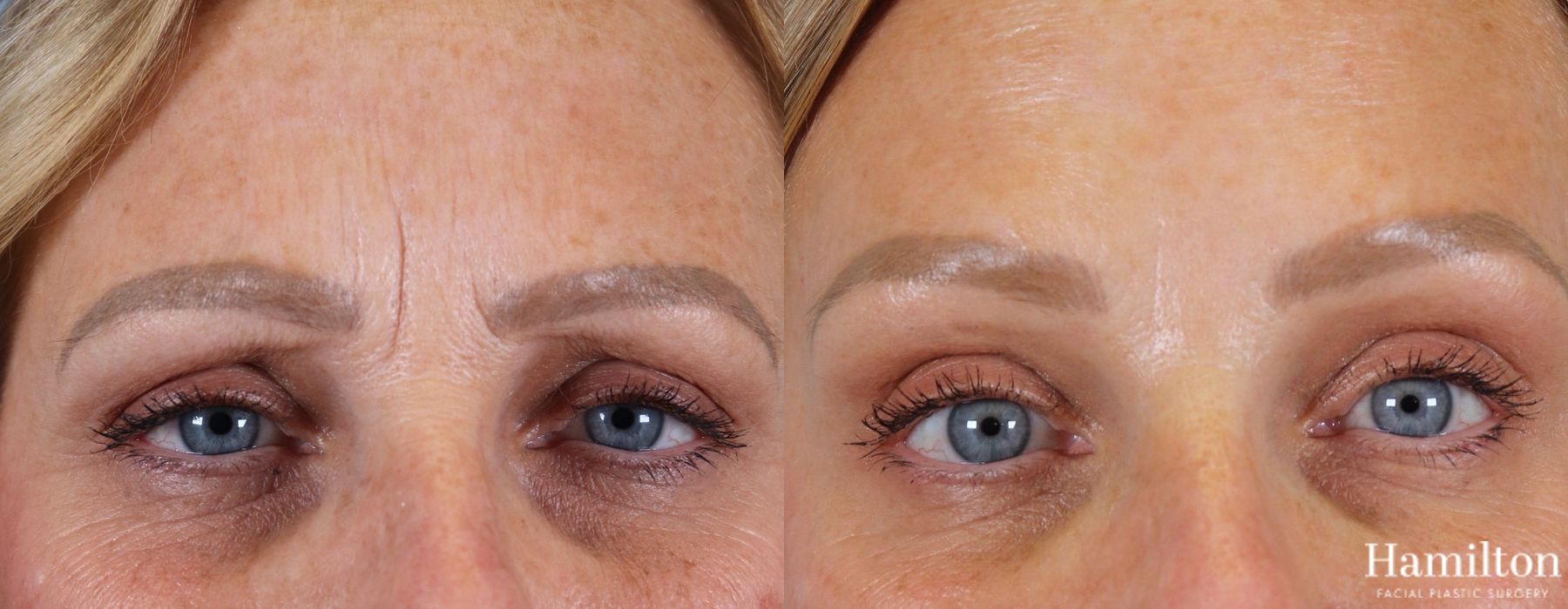 Before and after Neurotoxins/BOTOX case 37123