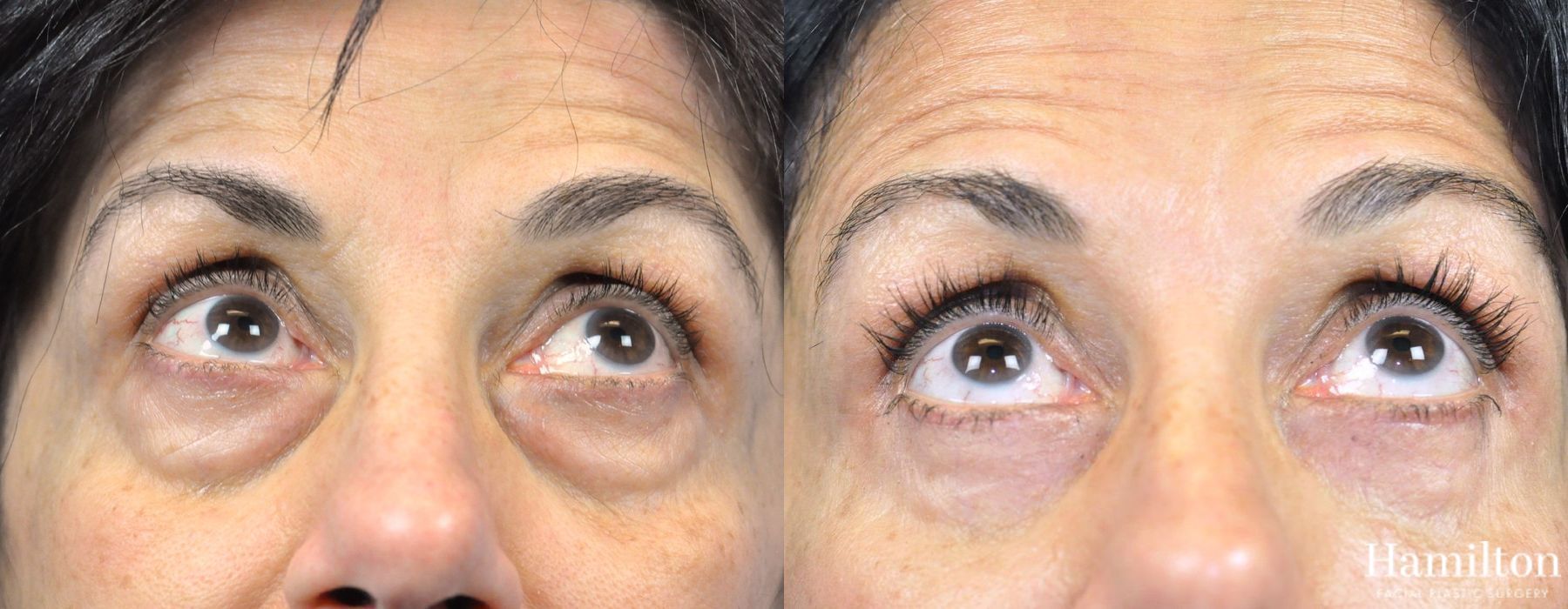 Before and after Blepharoplasty case 37262