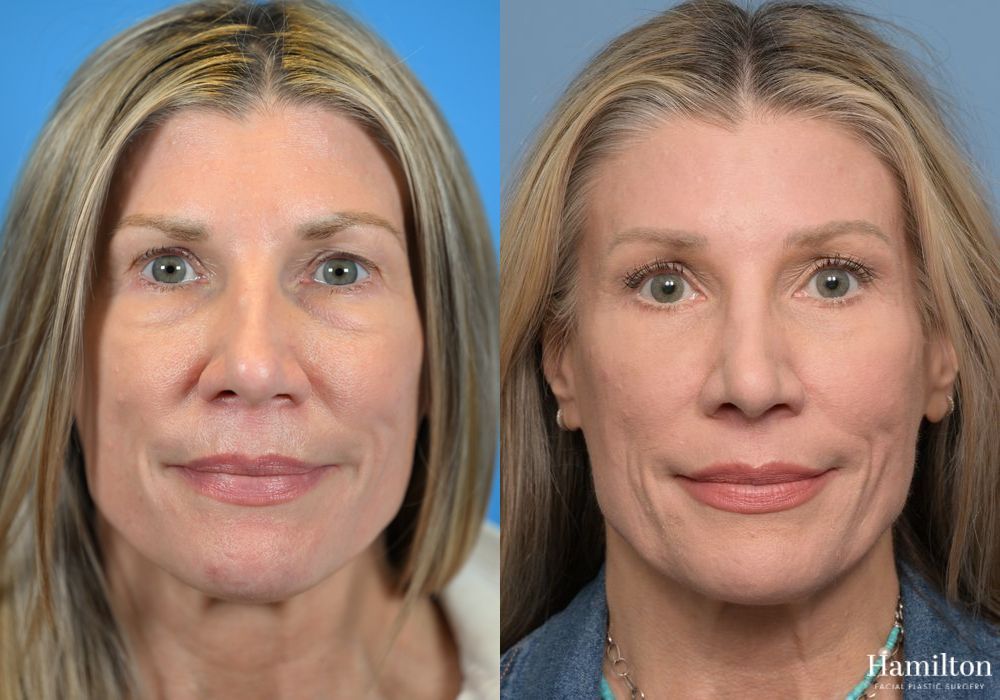 Before and after Brow Lift case 37196