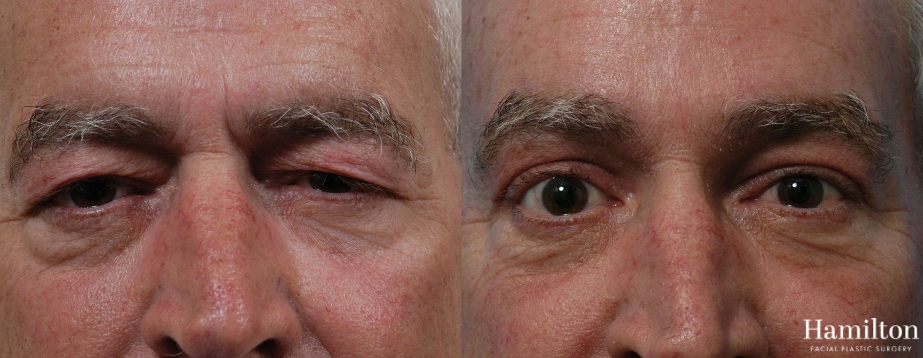 Before and after Blepharoplasty case 37280