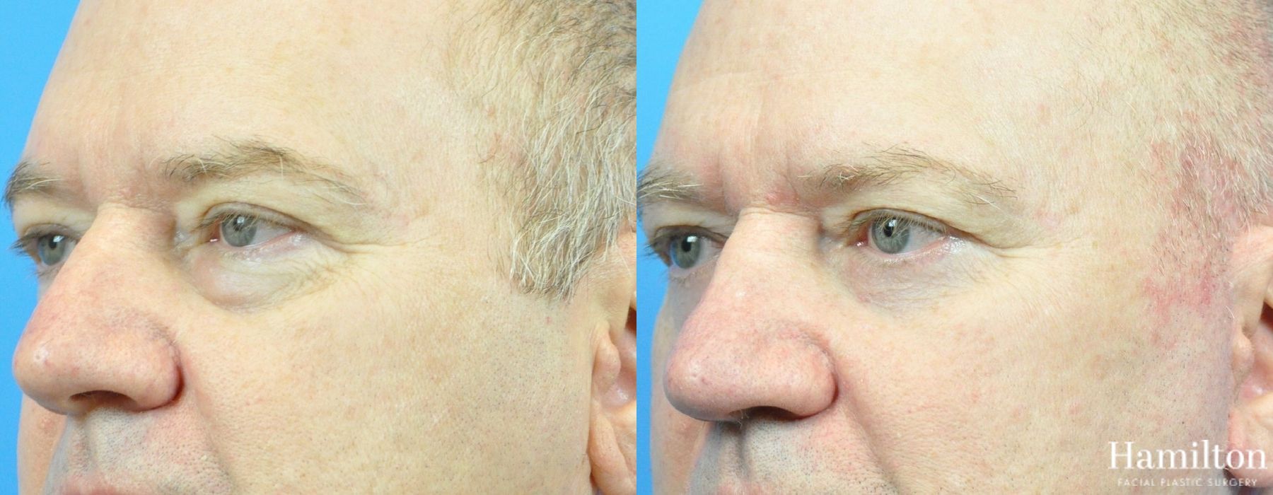 Before and after Blepharoplasty case 37282 - Angle 2