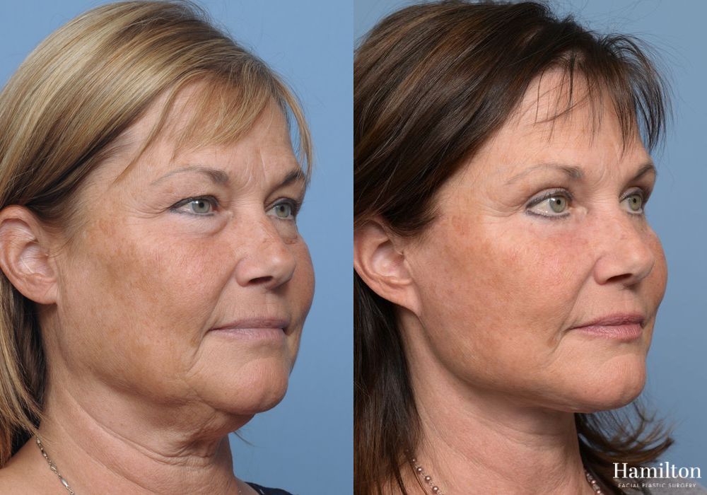 Before and after Facelift case 37258