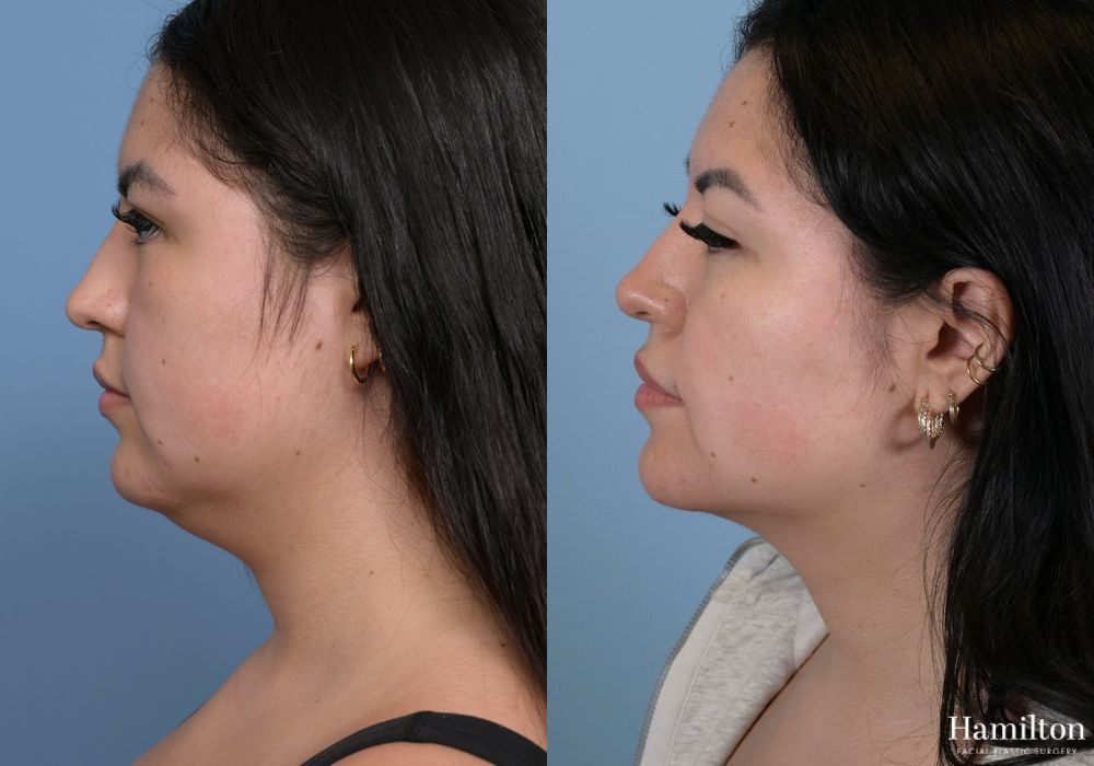 Before and after Submentoplasty/Deep Neck Lift case 37132