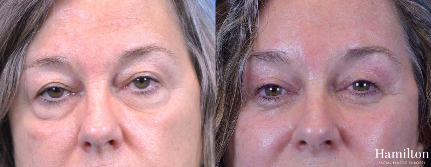 Before and after Blepharoplasty case 37310